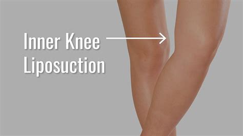 Why Are My Knees Fat: Exploring the Curious Case of Puffy Patellas